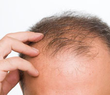 male-pattern-baldness-newsletter