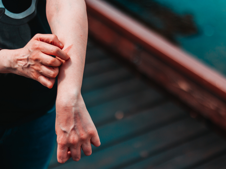 What's the Link Between Allergies and Eczema?