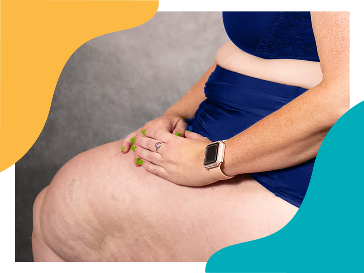 What’s the difference between cellulite and lipedema?