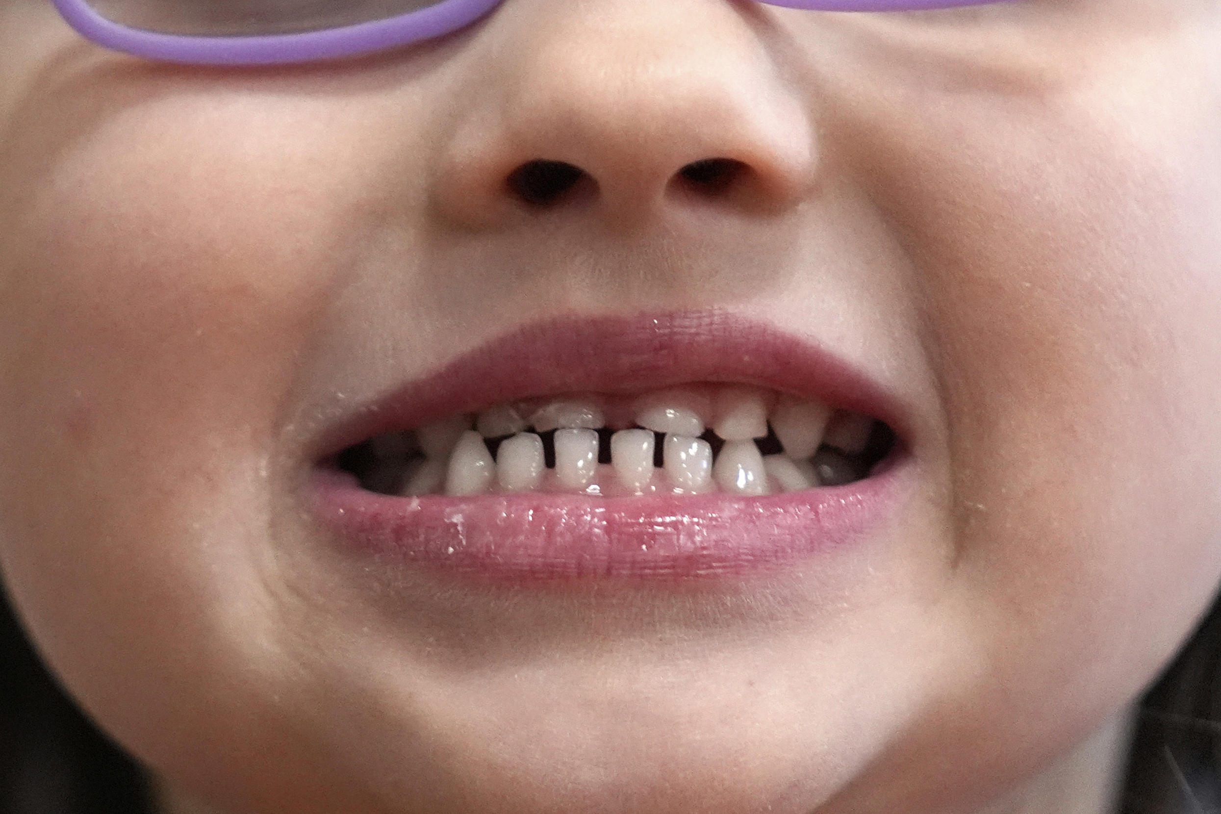 A child shows off her teeth after a dental exam in Concord, N.H., in 2024. (AP Photo/Robert F. Bukaty).