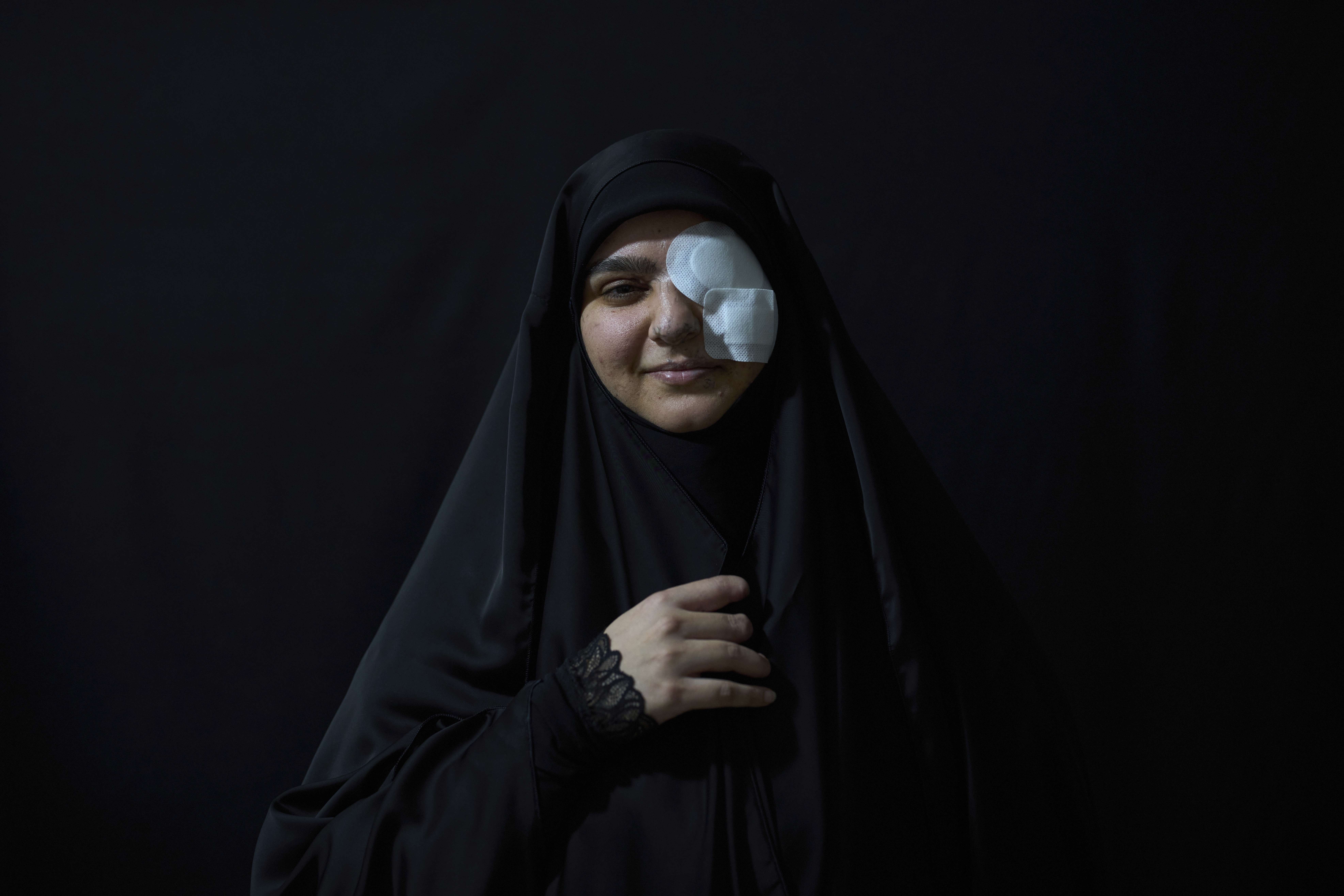 Zeinab Mestrah, 26, who was wounded in the pagers attack carried out by Israel on September 17, 2024, poses for a photograph in the Dahiyeh suburb of Beirut, Lebanon, Friday, April 25, 2025. (AP Photo/Hassan Ammar)