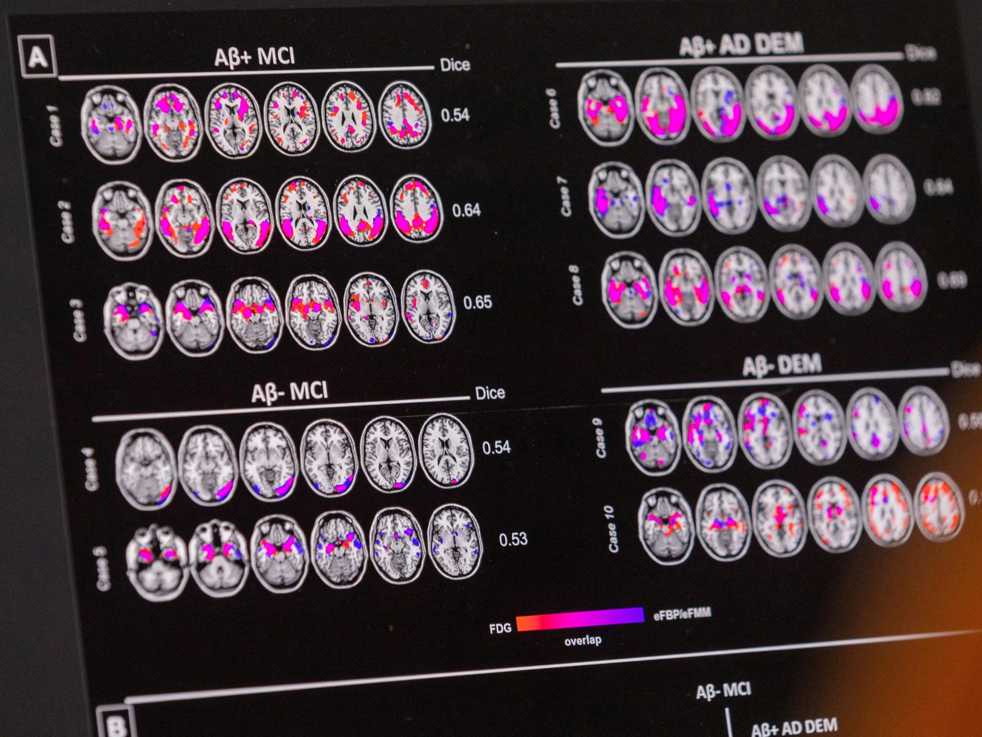 A scientist looks at hypometabolic and hypoperfusion patterns at the single-subject level from a patient with Alzheimer's disease at the Memory Centre, in Geneva, Switzerland, on June 6, 2023