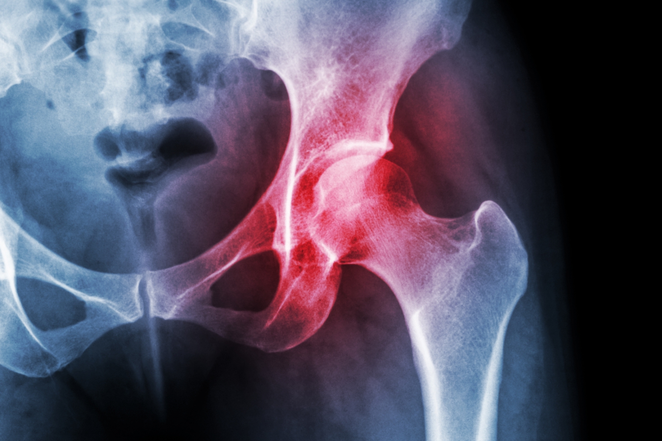 An X-ray shows the hip joint