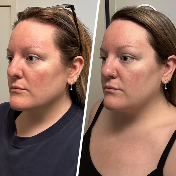 Dr. Brandt Microneedling Recovery Kit