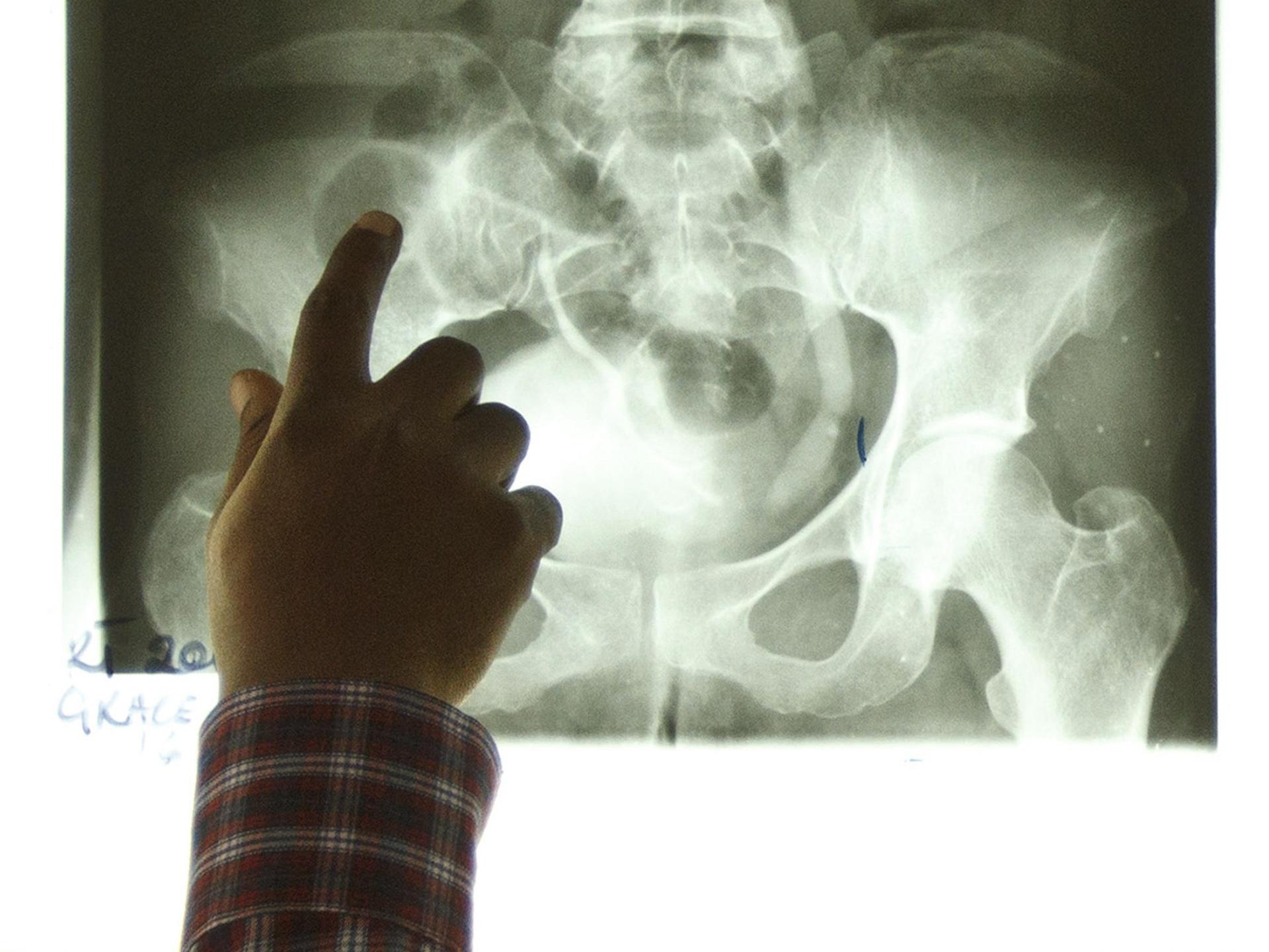 Radiotherapist Kofi Kyei, 30, points at a tumor on an X-ray from a patient suffering from bladder cancer, at the Korle Bu Teaching Hospital, in Accra, Ghana, on April 24, 2012. 
