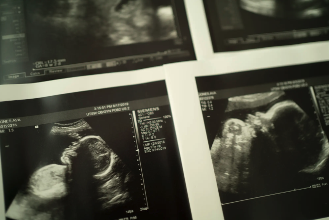 Ultrasound images of Giles Jones, who was stillborn to Ava Jones in 2019.